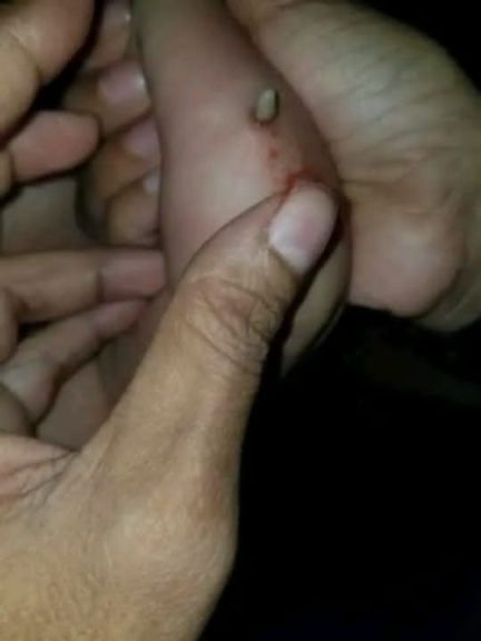 يمنيون يعيشون حالة من الرعب بعد إنتشار مرض خروج الدود من أجسامهم وخاصة الأطفال (صورة) يمنيون يعيشون حالة من الرعب بعد إنتشار مرض خروج الدود من أجسامهم وخاصة الأطفال (صورة)