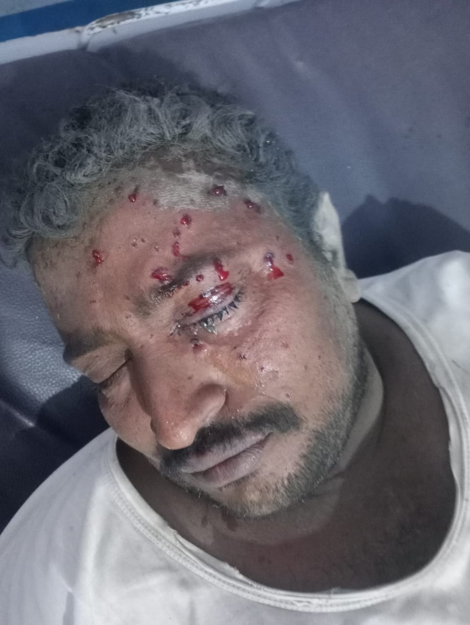 إصابة مواطن بجروح جراء انفجار لغـ,ـم زرعته مليشـ,ـيات الحـ,ـوثي شرق مديرية حيس - إصابة مواطن بجروح جراء انفجار لغـ,ـم زرعته مليشـ,ـيات الحـ,ـوثي شرق مديرية حيس -